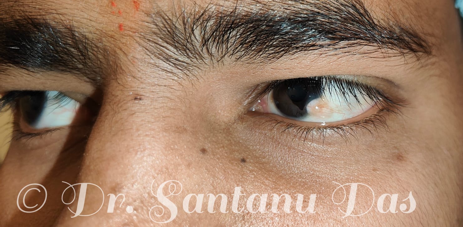 Ocular surface limbal dermoid